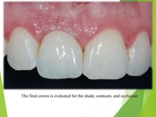 The final crown is evaluated for the shade, contours, and occlusion
 