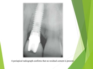 A periapical radiograph confirms that no residual cement is present.
 