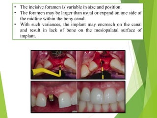 • The incisive foramen is variable in size and position.
• The foramen may be larger than usual or expand on one side of
the midline within the bony canal.
• With such variances, the implant may encroach on the canal
and result in lack of bone on the mesiopalatal surface of
implant.
 