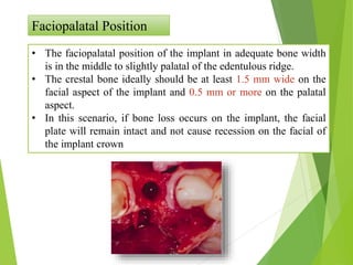 Faciopalatal Position
• The faciopalatal position of the implant in adequate bone width
is in the middle to slightly palatal of the edentulous ridge.
• The crestal bone ideally should be at least 1.5 mm wide on the
facial aspect of the implant and 0.5 mm or more on the palatal
aspect.
• In this scenario, if bone loss occurs on the implant, the facial
plate will remain intact and not cause recession on the facial of
the implant crown
 