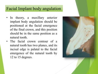 Facial Implant body angulation
• In theory, a maxillary anterior
implant body angulation should be
positioned at the facial emergence
of the final crown, and this position
should be in the same position as a
natural tooth.
• The facial crown contour of a
natural tooth has two planes, and its
incisal edge is palatal to the facial
emergence of the natural tooth by
12 to 15 degrees.
 