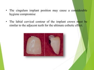• The cingulum implant position may cause a considerable
hygiene compromise
• The labial cervical contour of the implant crown must be
similar to the adjacent teeth for the ultimate esthetic effect.
 