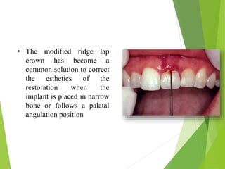 • The modified ridge lap
crown has become a
common solution to correct
the esthetics of the
restoration when the
implant is placed in narrow
bone or follows a palatal
angulation position
 