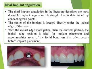 Ideal Implant angulation
• The third implant angulation in the literature describes the most
desirable implant angulation. A straight line is determined by
connecting two points
• The center of the implant is located directly under the incisal
edge of the crown.
• With the incisal edge more palatal than the cervical portion, the
incisal edge position is ideal for implant placement and
accommodates some of the facial bone loss that often occurs
before implant placement.
 