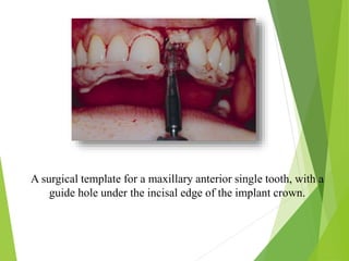 A surgical template for a maxillary anterior single tooth, with a
guide hole under the incisal edge of the implant crown.
 