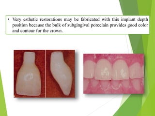 • Very esthetic restorations may be fabricated with this implant depth
position because the bulk of subgingival porcelain provides good color
and contour for the crown.
 