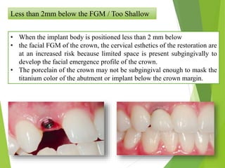 Less than 2mm below the FGM / Too Shallow
• When the implant body is positioned less than 2 mm below
• the facial FGM of the crown, the cervical esthetics of the restoration are
at an increased risk because limited space is present subgingivally to
develop the facial emergence profile of the crown.
• The porcelain of the crown may not be subgingival enough to mask the
titanium color of the abutment or implant below the crown margin.
 