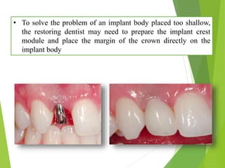 • To solve the problem of an implant body placed too shallow,
the restoring dentist may need to prepare the implant crest
module and place the margin of the crown directly on the
implant body
 
