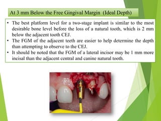 At 3 mm Below the Free Gingival Margin (Ideal Depth)
• The best platform level for a two-stage implant is similar to the most
desirable bone level before the loss of a natural tooth, which is 2 mm
below the adjacent tooth CEJ.
• The FGM of the adjacent teeth are easier to help determine the depth
than attempting to observe to the CEJ.
• It should be noted that the FGM of a lateral incisor may be 1 mm more
incisal than the adjacent central and canine natural tooth.
 
