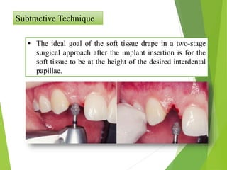 Subtractive Technique
• The ideal goal of the soft tissue drape in a two-stage
surgical approach after the implant insertion is for the
soft tissue to be at the height of the desired interdental
papillae.
 