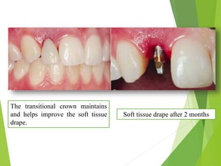 The transitional crown maintains
and helps improve the soft tissue
drape.
Soft tissue drape after 2 months
 