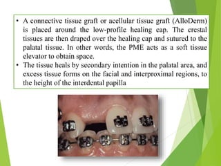 • A connective tissue graft or acellular tissue graft (AlloDerm)
is placed around the low-profile healing cap. The crestal
tissues are then draped over the healing cap and sutured to the
palatal tissue. In other words, the PME acts as a soft tissue
elevator to obtain space.
• The tissue heals by secondary intention in the palatal area, and
excess tissue forms on the facial and interproximal regions, to
the height of the interdental papilla
 