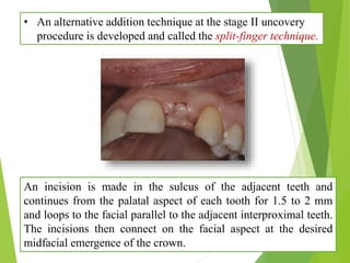 • An alternative addition technique at the stage II uncovery
procedure is developed and called the split-finger technique.
An incision is made in the sulcus of the adjacent teeth and
continues from the palatal aspect of each tooth for 1.5 to 2 mm
and loops to the facial parallel to the adjacent interproximal teeth.
The incisions then connect on the facial aspect at the desired
midfacial emergence of the crown.
 