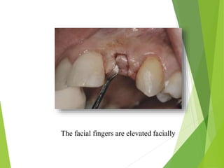 The facial fingers are elevated facially
 