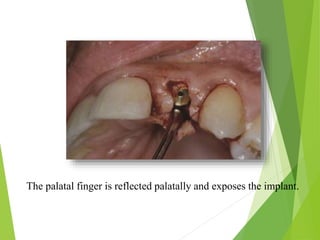 The palatal finger is reflected palatally and exposes the implant.
 