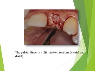 The palatal finger is split into two sections (mesial and
distal)
 