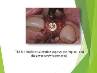 The full-thickness elevation exposes the implant, and
the cover screw is removed.
 
