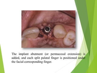 The implant abutment (or permucosal extension) is
added, and each split palatal finger is positioned under
the facial corresponding finger.
 