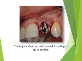 The implant abutment and elevated facial fingers
are in position.
 