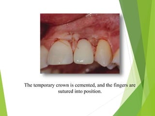 The temporary crown is cemented, and the fingers are
sutured into position.
 