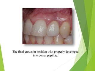 The final crown in position with properly developed
interdental papillae.
 