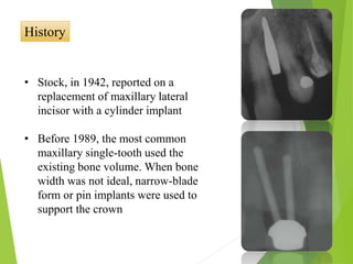 History
• Stock, in 1942, reported on a
replacement of maxillary lateral
incisor with a cylinder implant
• Before 1989, the most common
maxillary single-tooth used the
existing bone volume. When bone
width was not ideal, narrow-blade
form or pin implants were used to
support the crown
 