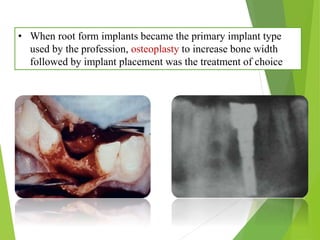 • When root form implants became the primary implant type
used by the profession, osteoplasty to increase bone width
followed by implant placement was the treatment of choice
 