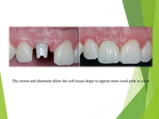 The crown and abutment allow the soft tissue drape to appear more coral pink in color
 