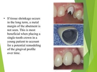 • If tissue shrinkage occurs
in the long term, a metal
margin of the abutment is
not seen. This is most
beneficial when placing a
single-tooth crown in a
young patient to account
for a potential remodeling
of the gingival profile
over time.
 