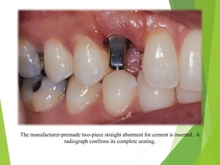 The manufacturer-premade two-piece straight abutment for cement is inserted. A
radiograph confirms its complete seating.
 