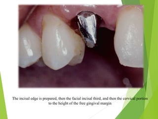 The incisal edge is prepared, then the facial incisal third, and then the cervical portion
to the height of the free gingival margin
 