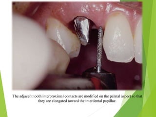 The adjacent tooth interproximal contacts are modified on the palatal aspect so that
they are elongated toward the interdental papillae.
 