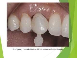 A temporary crown is fabricated level with the soft tissue margin.
 