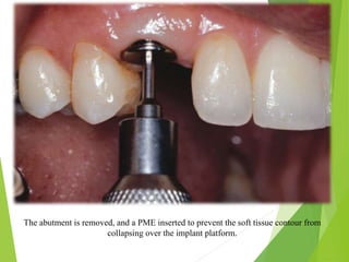 The abutment is removed, and a PME inserted to prevent the soft tissue contour from
collapsing over the implant platform.
 