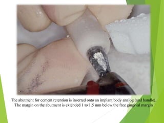 The abutment for cement retention is inserted onto an implant body analog (and handle).
The margin on the abutment is extended 1 to 1.5 mm below the free gingival margin
 