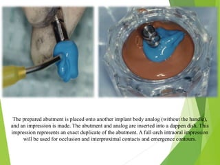 The prepared abutment is placed onto another implant body analog (without the handle),
and an impression is made. The abutment and analog are inserted into a dappen dish. This
impression represents an exact duplicate of the abutment. A full-arch intraoral impression
will be used for occlusion and interproximal contacts and emergence contours.
 