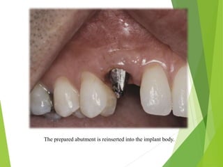 The prepared abutment is reinserted into the implant body.
 