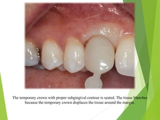 The temporary crown with proper subgingival contour is seated. The tissue blanches
because the temporary crown displaces the tissue around the margin.
 