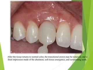 After the tissue returns to normal color, the transitional crown may be removed, and a
final impression made of the abutment, soft tissue emergence, and surrounding teeth.
 