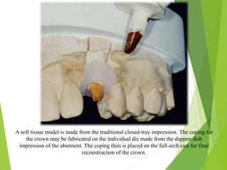 A soft tissue model is made from the traditional closed-tray impression. The coping for
the crown may be fabricated on the individual die made from the dappen dish
impression of the abutment. The coping then is placed on the full-arch cast for final
reconstruction of the crown.
 