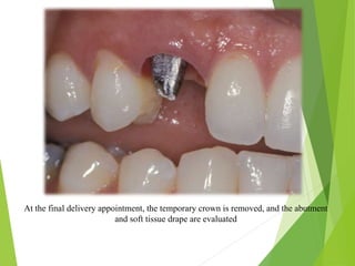 At the final delivery appointment, the temporary crown is removed, and the abutment
and soft tissue drape are evaluated
 