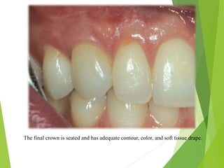 The final crown is seated and has adequate contour, color, and soft tissue drape.
 