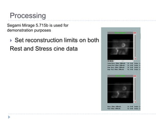 Processing
 Set reconstruction limits on both
Rest and Stress cine data
Segami Mirage 5.715b is used for
demonstration purposes
 