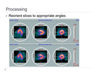 Processing
 Reorient slices to appropriate angles
 