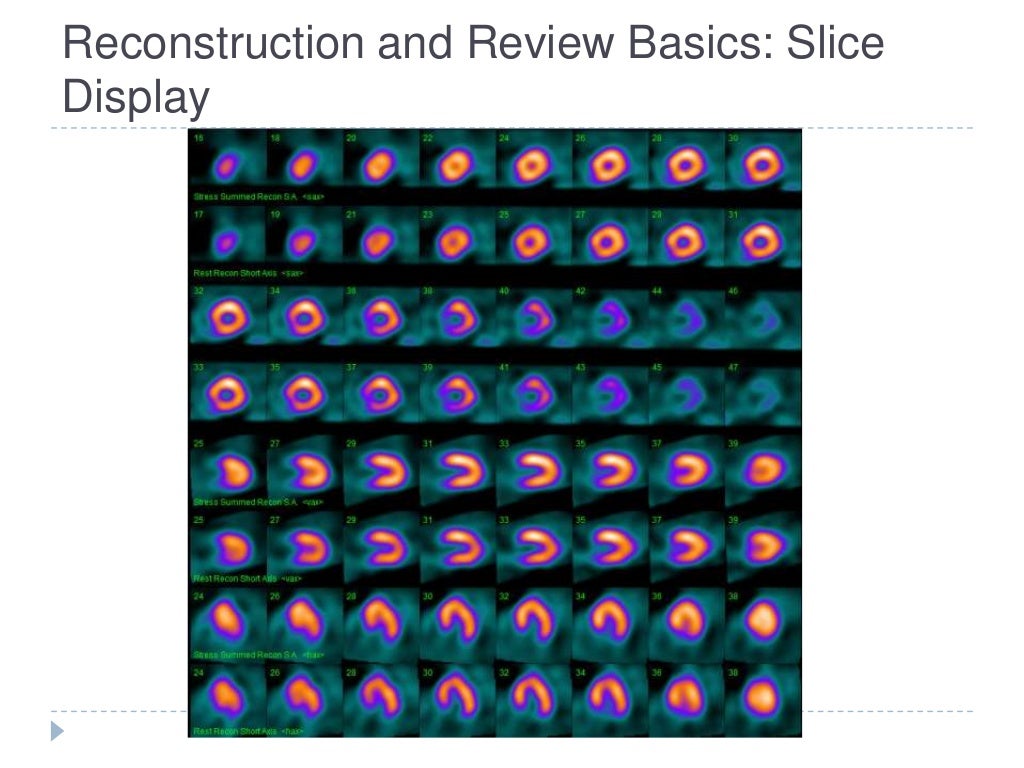 Myocardial perfusion imaging SPECT basics