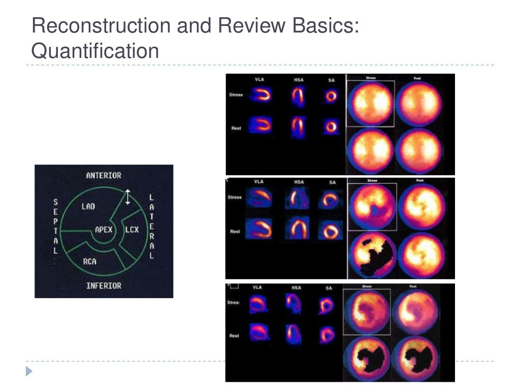 Myocardial perfusion imaging SPECT basics