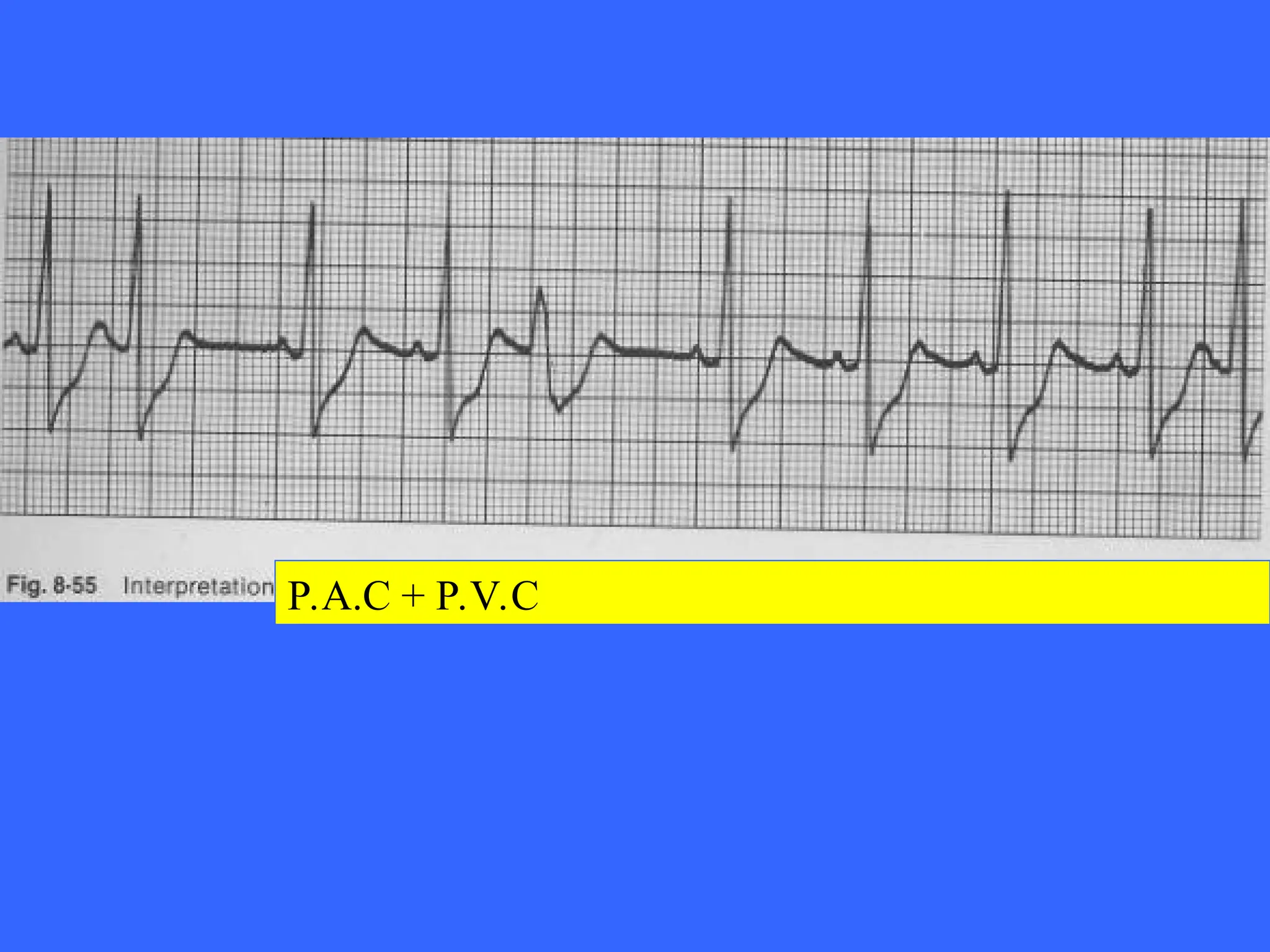 12O of ECG for learning and practicing cardiolog PPT