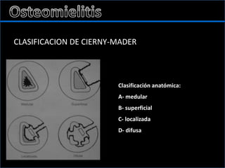 CLASIFICACION DE CIERNY-MADER
Clasificación anatómica:
A- medular
B- superficial
C- localizada
D- difusa
 