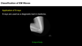 Application of X-rays
X-rays are used as a diagnostic tool in medicine.
X-rays of body
Classification of EM Waves
 