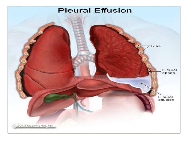 Pleural effusion